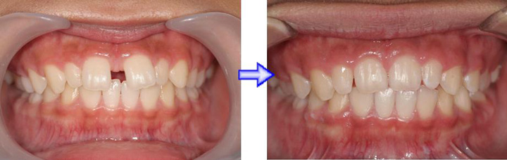 非抜歯矯正