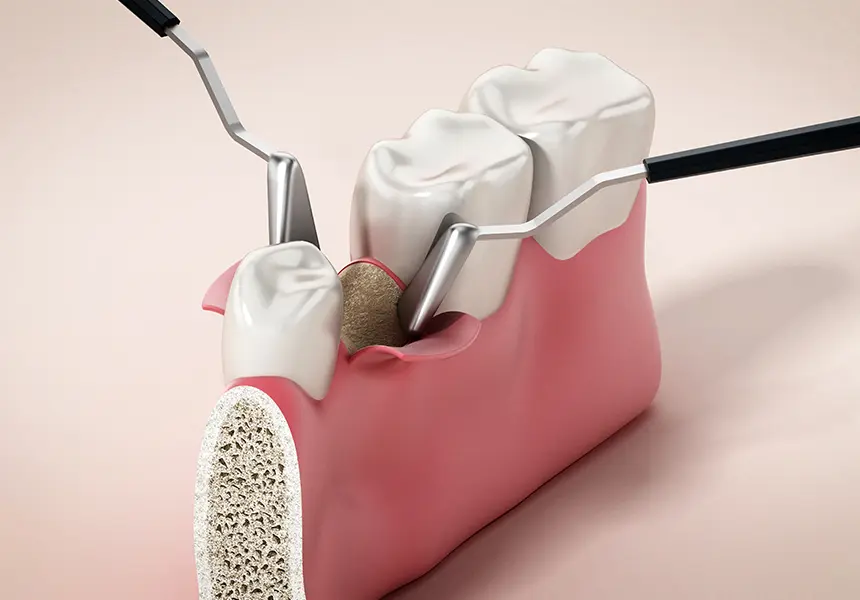 歯周外科治療